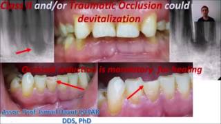 Endodontide Karşılaşılan Problemler ve Çözüm Yöntemleri 1 edit edilmiş [upl. by Ardin]