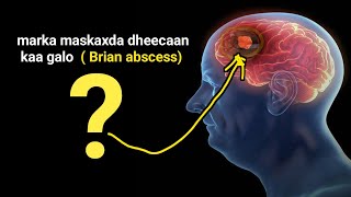 dheecaanka Gala maskaxda ee sababa caabuqa ama jeermiska  Brain abscess [upl. by Nosnor]