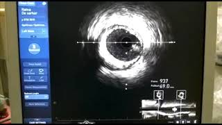 IVUS in Angioplasty [upl. by Drooff]