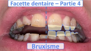 Facette dentaire et Bruxisme  Guide complet  Partie 4 [upl. by Cy]