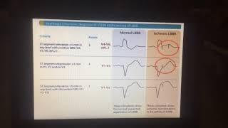 Sgarbossa criteria [upl. by Kired]