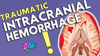 Intracranial Hemorrhage [upl. by Filler]