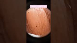 Blackheads Removal  Acne Treatment and Very Satisfying Satisfying Pimple pop blackheads [upl. by Germain]