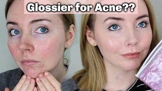 Glossier for Acne Prone Skin  Does it Work My Tips [upl. by Neeroc]