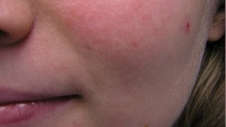 Rosacea  What causes it [upl. by Namzaj]