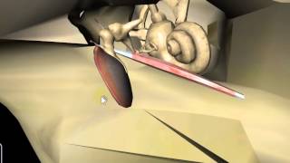 TYMPANIC MEMBRANE BY DR SAMEH GHAZY [upl. by Lasiaf921]