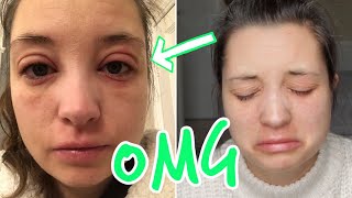 ALLERGIC REACTION  SWOLLEN EYES  ECZEMA FLARE UP  INFECTED ECZEMA [upl. by Reisman]