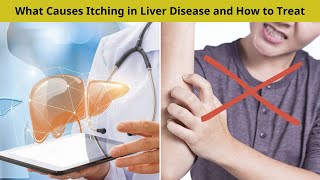 What Causes Itching in Liver Disease and How to Treat  Nuse Healthy [upl. by Salomo511]