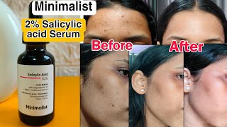 Minimalist 2 Salicylic acid Face Serum  My Honest Review  How I cleared my Skin✅ [upl. by Vorfeld]