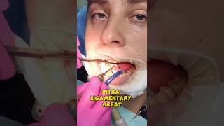 Dental Anesthesia Explained Stay PainFree at the Dentist shorts [upl. by Malony681]