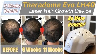 11 Weeks Update  Theradome EVO LH40 Laser Hair Growth Device [upl. by Swartz]