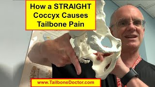 How a STRAIGHT Coccyx Causes Coccyx Pain Tailbone Pain Coccydynia [upl. by Limhaj266]