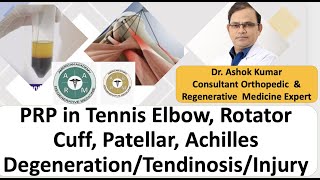 Dr Ashok Kumar PRP in Tendon Achilles Tendonitis Rotator Cuff Patellar Tendinitis Tennis Elbow [upl. by Sky]