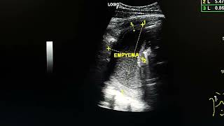 Chest ultrasound shows empyema in a female Hx renal failure [upl. by Rocky]