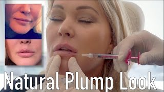 Natural Plump Look with Volbella Filler ft Shanna Moakler [upl. by Jud]