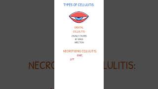 ORBITAL amp NECROTIZING CELLULITIS [upl. by Amathist675]