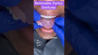 Removable Partial Dentures [upl. by Kitchen]