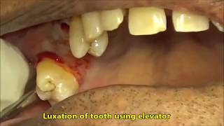 Physics forcep Extraction of upper right molars [upl. by Hahcim]