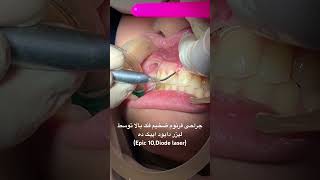 Diode laser frenectomy by Dr Ali Heidari [upl. by Pond132]