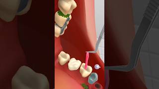 teeth RCT and cleaning kidsvideo satisfying animationvideo asmrvideo [upl. by Yeleak690]