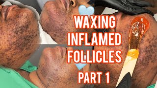 Waxing Inflamed Follicles Part 1  NEW Client Alert This Is Hirsutism [upl. by Lupiv330]