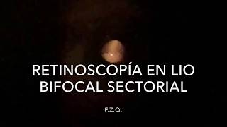 Retinoscopía con LIO bifocal sectorial [upl. by Zetrok]