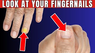 Fingernails Warning You 7 Signs You Have Health Problems [upl. by Anikal34]