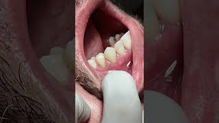 Tooth crowns after RCT satisfying [upl. by Oballa]