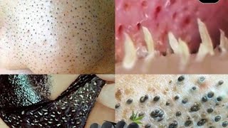 Isto Elimina ESPINHAS Inflamadas e Tira Cravo No Nariz em 1 Noite😱😱😱 [upl. by Hurlbut]