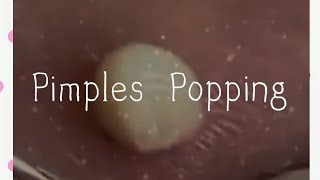 Pimples amp Blackheads Popping  59 [upl. by Reel]