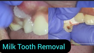 How a Dentist Remove Tooth in a Child I Pediatric Tooth Extraction Procedure [upl. by Sukin727]