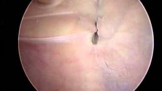 Arthroscopic Lateral Release and VMO Plication  ORV  Stanley Tao MD [upl. by Turner]