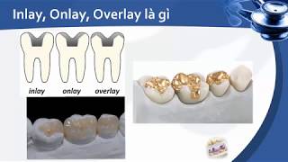 INLAY và ONLAY LÀ GÌ  KĨ THUẬT MÀI INLAY và ONLAY NHƯ THẾ NÀO ranghamnho [upl. by Ras126]