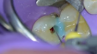 Root Canal Procedure Technique Premolar w Gentle Wave [upl. by Llehcear313]