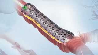 AERO® Fully Covered Tracheobronchial Stent Video [upl. by Kaia]