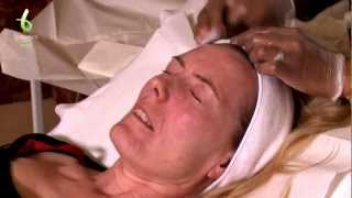 Skin Peel Treatment [upl. by Bonny]