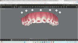 Invisalign  step by step guide [upl. by Inna77]