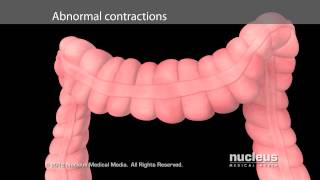 Irritable Bowel Syndrome IBS [upl. by Briana]