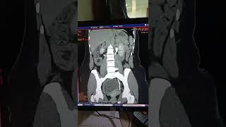 Ct Urographycectge healthcare [upl. by Nivalc]