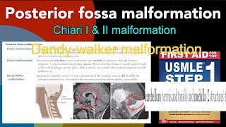 Posterior fossa malformations Chiari 1 amp 2 malformation DandyWalker malformation in HindiUrdu [upl. by Marissa]