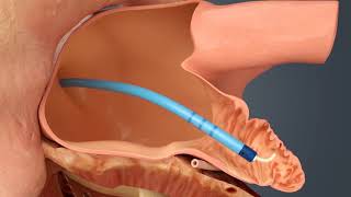 WATCHMAN Procedure for Atrial Fibrillation [upl. by Gibbs]