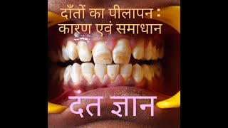 DANT GYAN 3 Yellow teeth Reason and treatment दंत ज्ञान दाँतों का पीलापन  कारण रोकथाम एवम इलाज़ [upl. by Skees276]