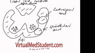 Central Cord Syndrome [upl. by Cassey]