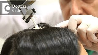 What is the chemical action of Mesotherapy on hair loss  Dr K Prapanna Arya [upl. by Eecram]