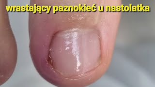 wrastający paznokieć ingrowntoenails podopogotowie [upl. by Teerprug]