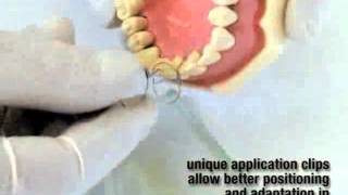 FiberSplint  Dentistry  teeth stabilization amp splinting by Polydentia [upl. by Courtund]