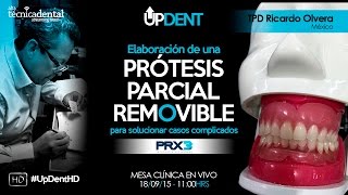 Elaboración de una Prótesis Parcial Removible para solucionar casos complicados [upl. by Eissim]