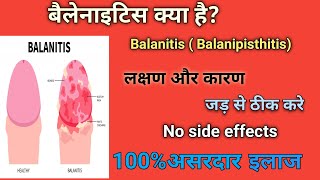 बैलेनाइटिस  Balanitis Best Treatment of Balanitis  cause ✅ Best Homeopathic Doctor in India ✅ [upl. by Eiznekam144]