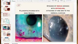 Non infective keratitis [upl. by Michiko]