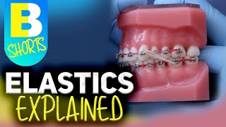 Braces Elastics Explained shorts [upl. by Ynitsed]